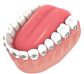 Braces Treatment
