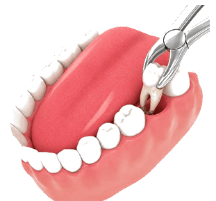 Tooth Extraction