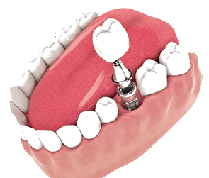 Dental Implant