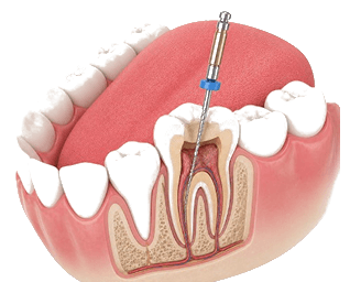 Root Canal Treatment